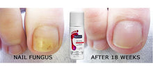 Load image into Gallery viewer, Picture of before and after 18 weeks after usung Footlogix Anti-Fungal Spray.  Footlogix Anti-fungal Toe Tincture is An effective spray, containing the proprietary anti-microbial ingredient Spiraleen®, is proven to provide care for unsightly toenails prone to fungal infections. Contains Avocado oil and Panthenol to restore toenails to optimum health.
