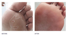 Load image into Gallery viewer, Footlogix Peeling Skin before and after use pictures
